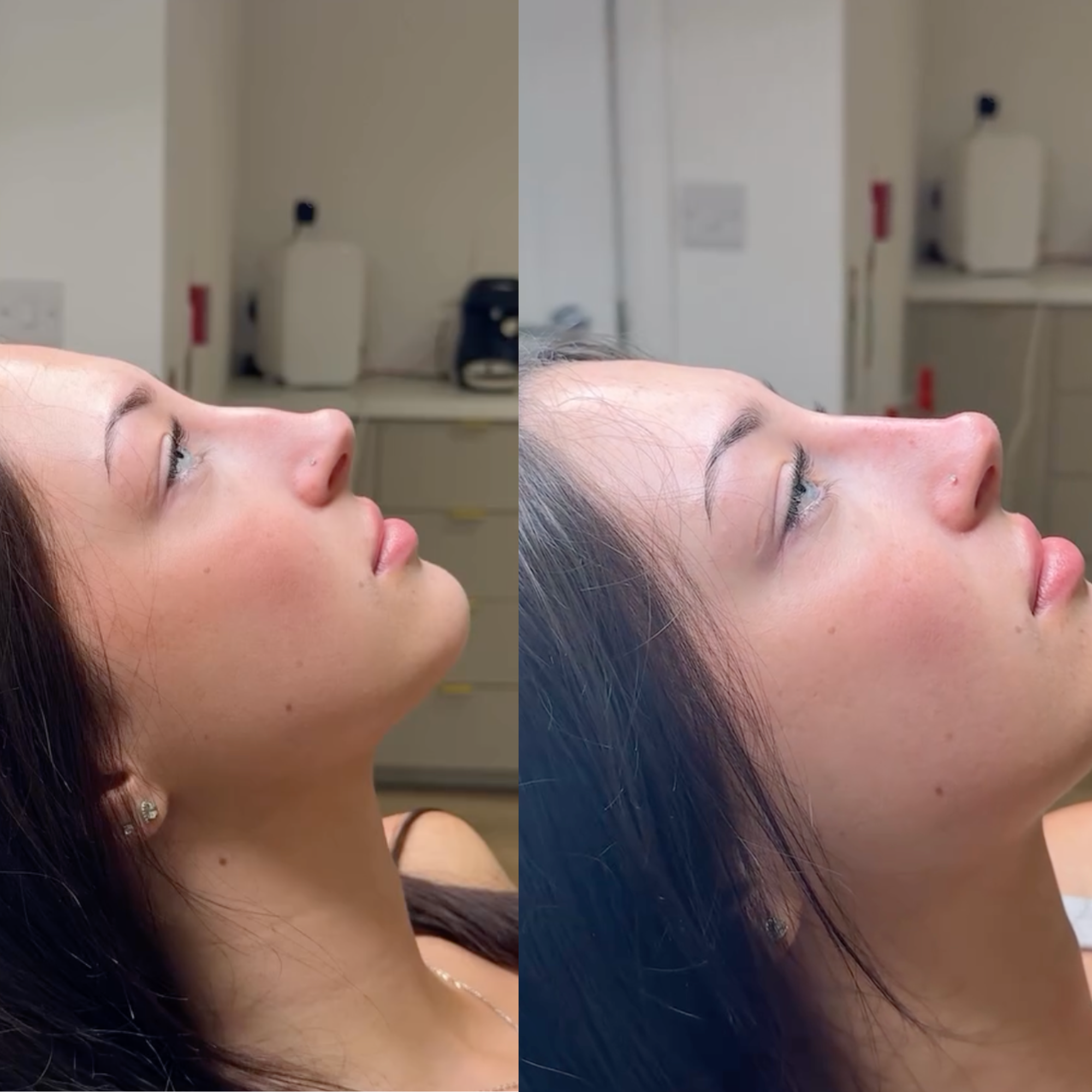 Image - Aesthetica Nose Filler Ad