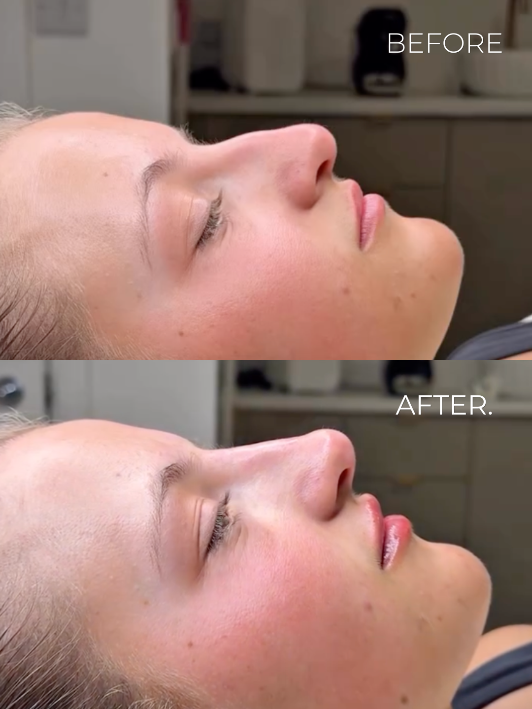 Image - Nose Filler - Small Curve - B&A Style 2