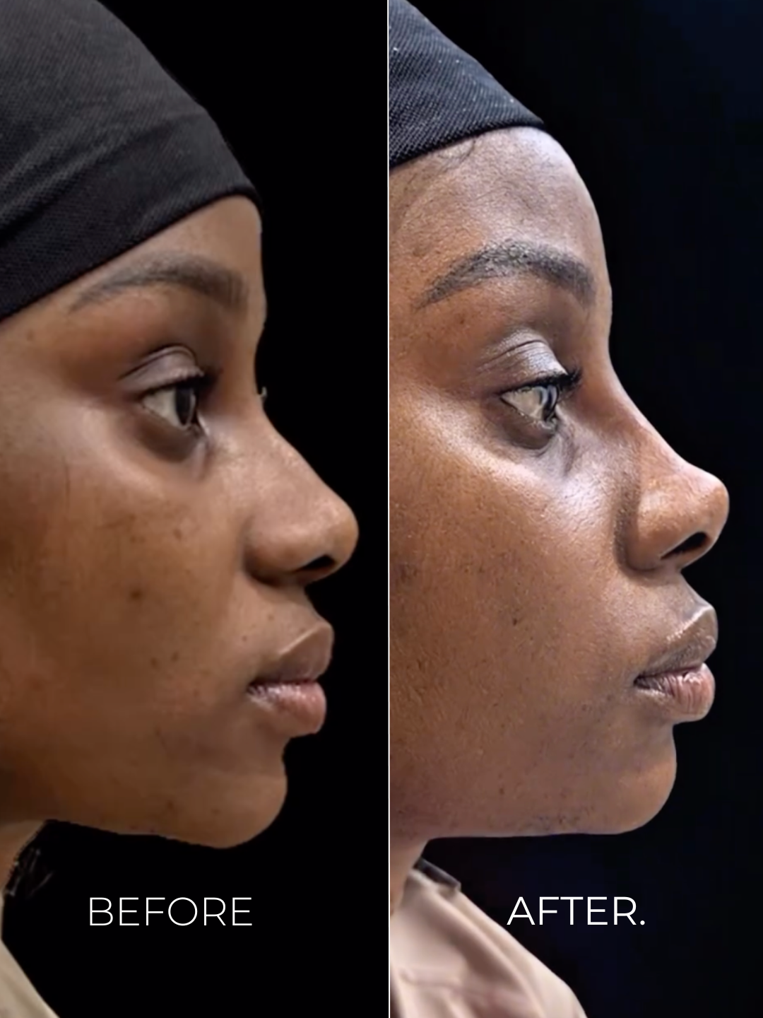 Image - Nose Filler - Tip Lift - B&A