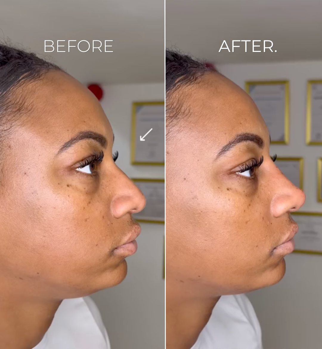 Image - Nose Filler - Tip&Bridge - B&A