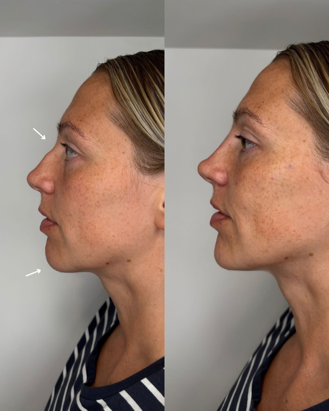 Noseandchin