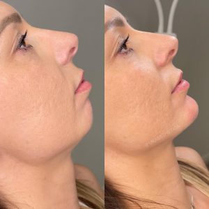 B&A - Chin Filer x2