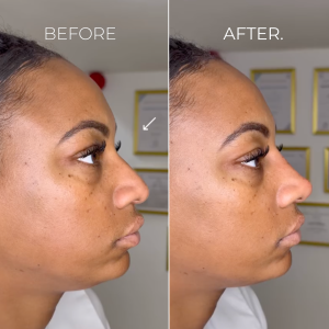 Image - Nose Filler - Tip&Bridge - B&A